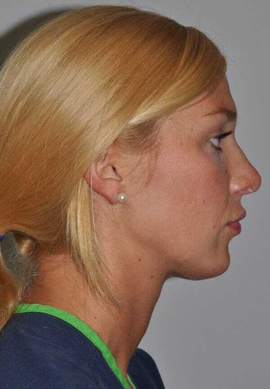 Rhinoplasty Before & After Patient #6087
