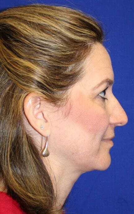 Rhinoplasty Before & After Patient #6099