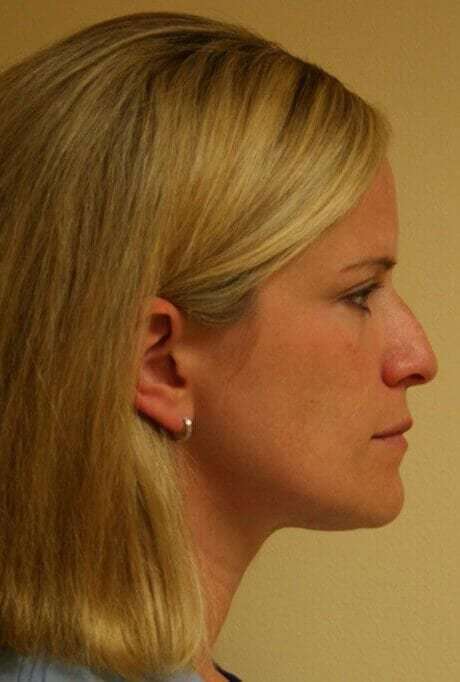 Rhinoplasty Before & After Patient #6106