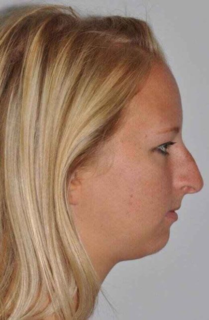 Rhinoplasty Before & After Patient #6113