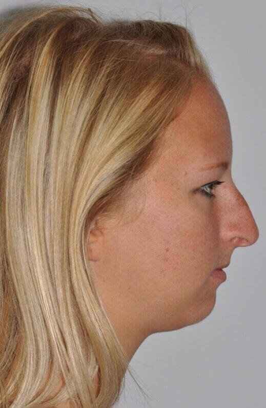 Rhinoplasty Before & After Patient #6113