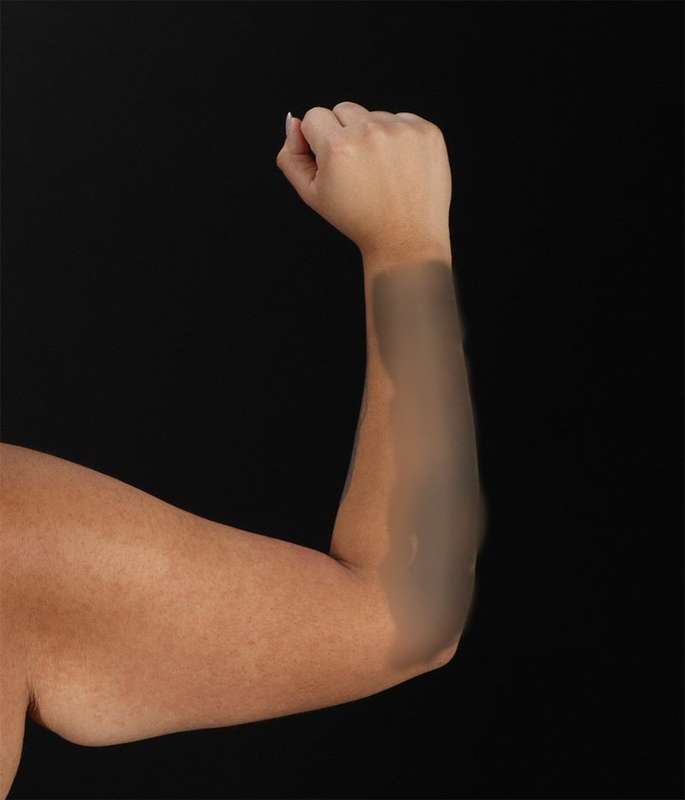 Brachioplasty (Arm Lift) Before & After Patient #1150