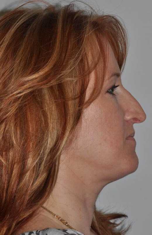 Rhinoplasty Before & After Patient #6120