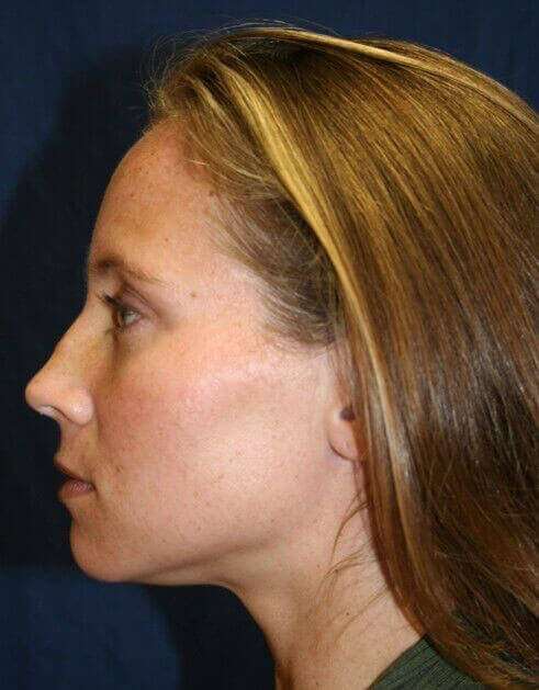 Rhinoplasty Before & After Patient #6132