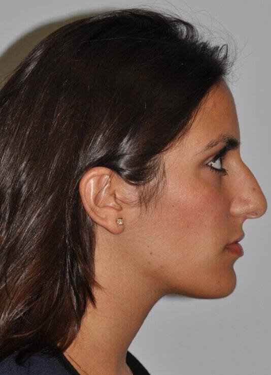 Rhinoplasty Before & After Patient #6139