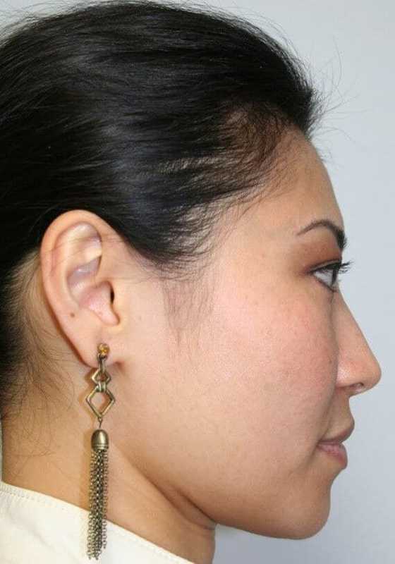 Rhinoplasty Before & After Patient #6146