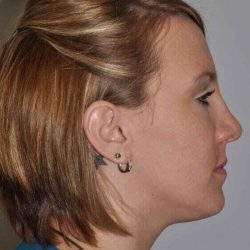 Rhinoplasty Before & After Patient #6153