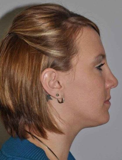 Rhinoplasty Before & After Patient #6153