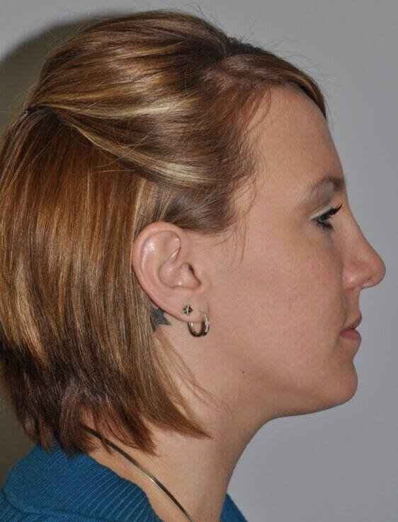 Rhinoplasty Before & After Patient #6153