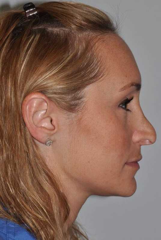 Rhinoplasty Before & After Patient #6160