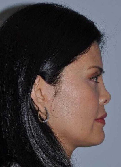 Rhinoplasty Before & After Patient #6167