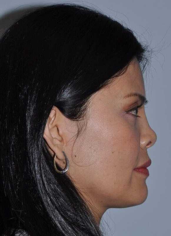 Rhinoplasty Before & After Patient #6167