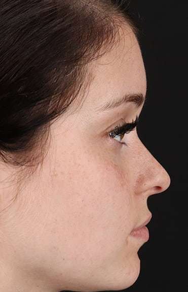 Rhinoplasty Before & After Patient #6178