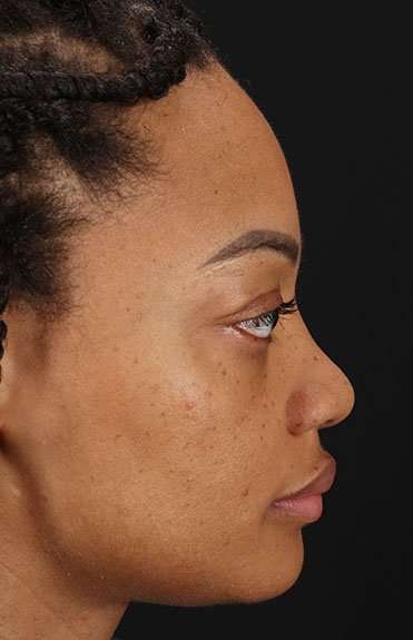Rhinoplasty Before & After Patient #6189