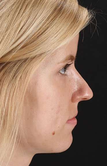 Rhinoplasty Before & After Patient #6200