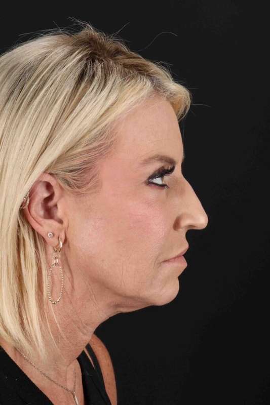 Rhinoplasty Before & After Patient #6211