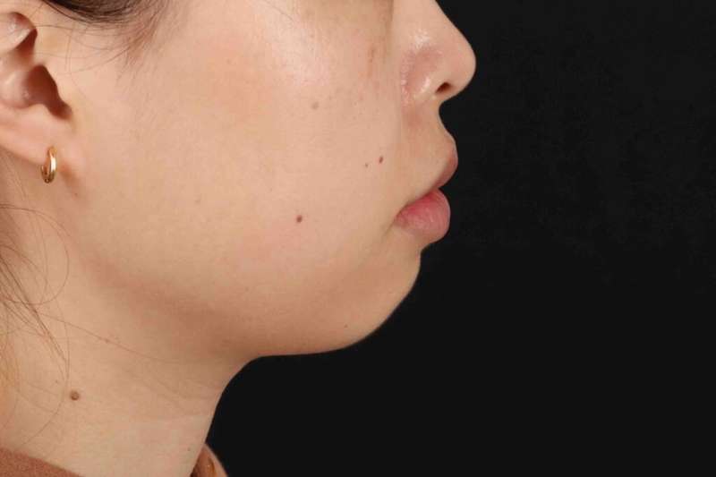 Lip Reduction Before & After Patient #6222
