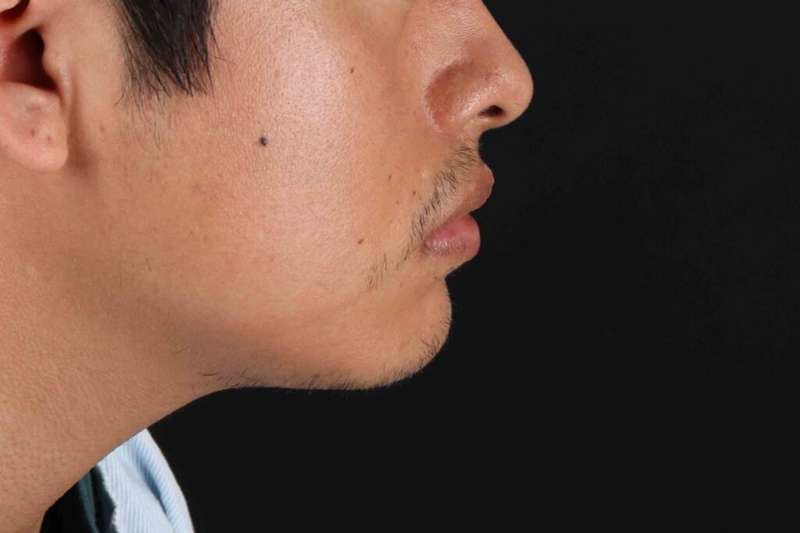 Lip Reduction Before & After Patient #6233
