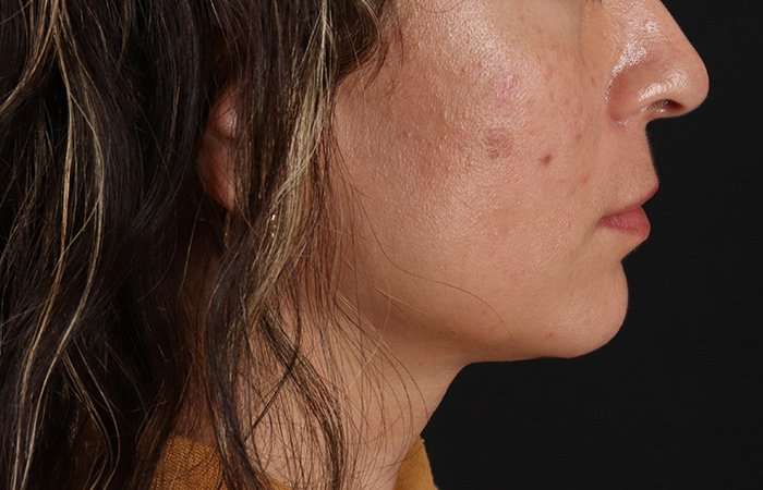 Lip Lift Before & After Patient #6244