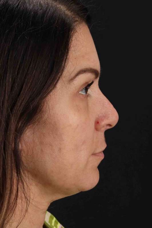 Lip Lift Before & After Patient #6277