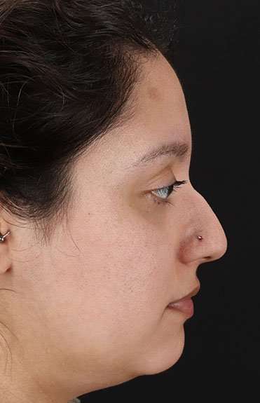 Liquid Rhinoplasty Before & After Patient #6299