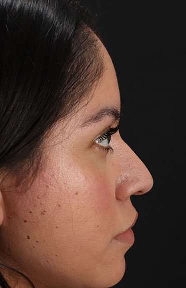 Liquid Rhinoplasty Before & After Patient #6319
