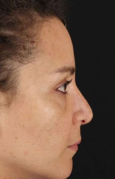 Liquid Rhinoplasty Before & After Patient #6333
