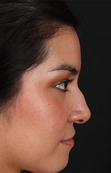 Liquid Rhinoplasty Before & After Patient #6344