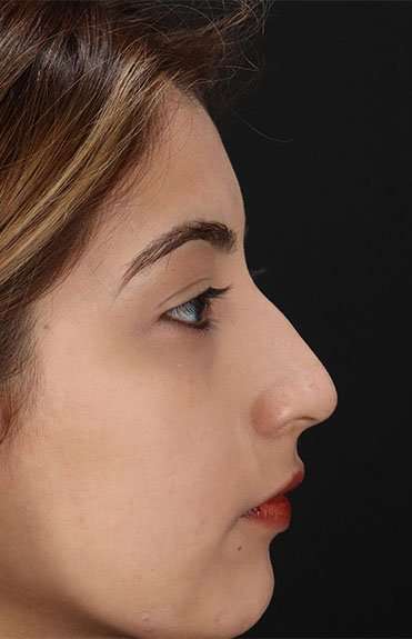 Liquid Rhinoplasty Before & After Patient #6355