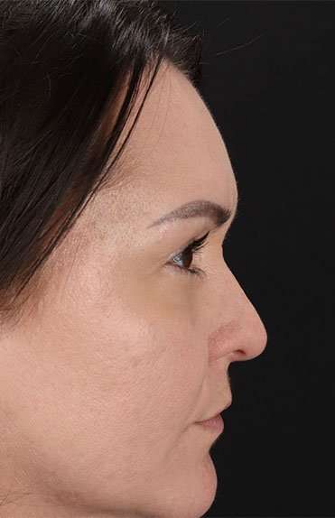 Liquid Rhinoplasty Before & After Patient #6366