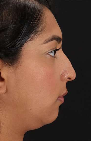 Liquid Rhinoplasty Before & After Patient #6377