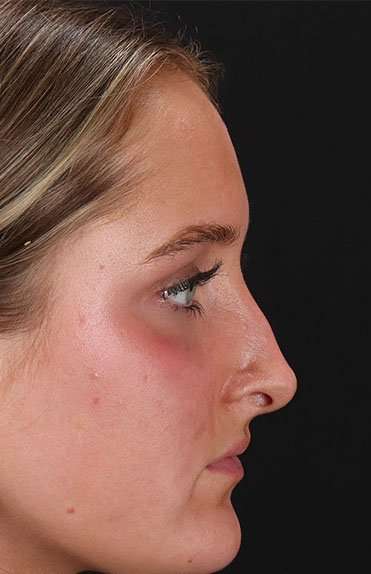 Liquid Rhinoplasty Before & After Patient #6388