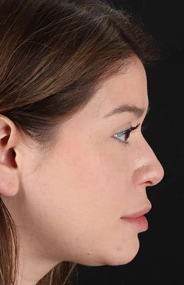 Liquid Rhinoplasty Before & After Patient #6399