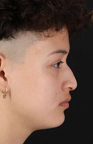 Liquid Rhinoplasty Before & After Patient #6410