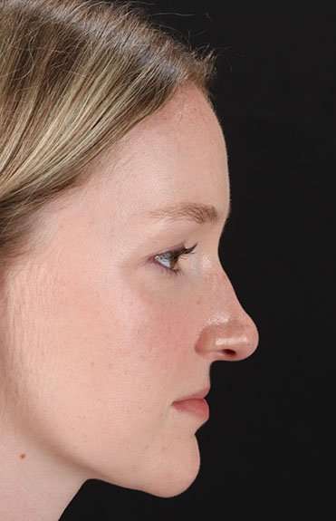 Liquid Rhinoplasty Before & After Patient #6425