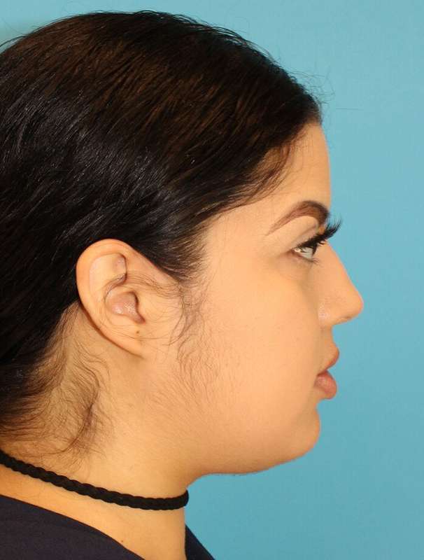Buccal Fat Pad Before & After Patient #6436