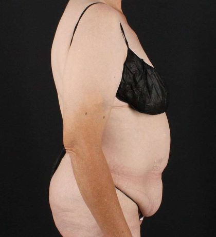 Cosmetic Body Lift Before & After Patient #1218