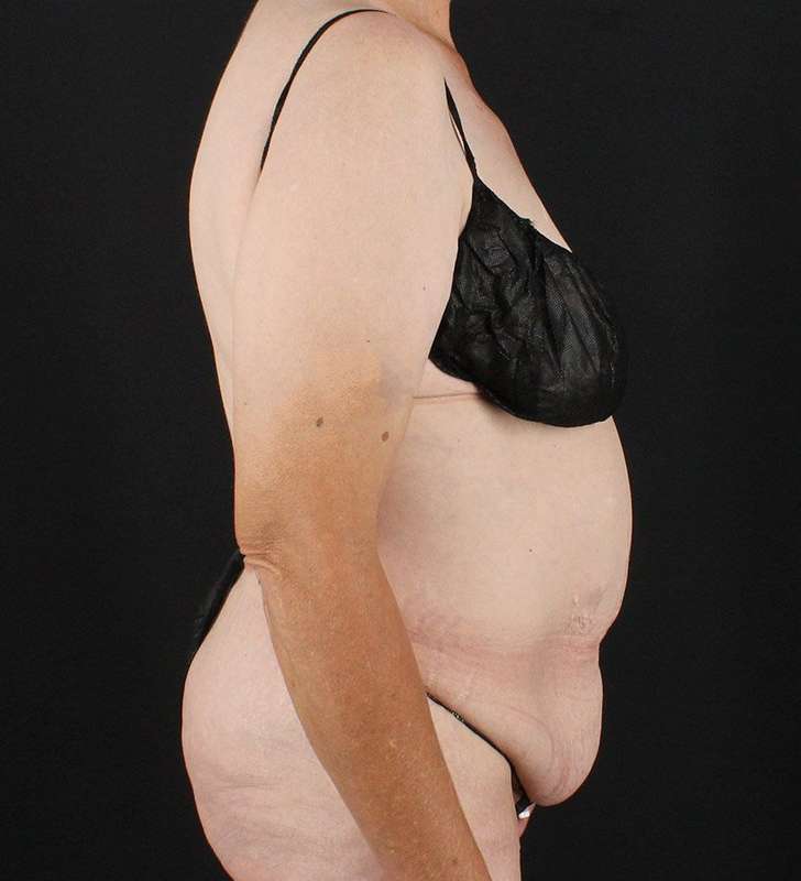 Cosmetic Body Lift Before & After Patient #1218