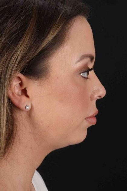 Buccal Fat Pad Before & After Patient #6474