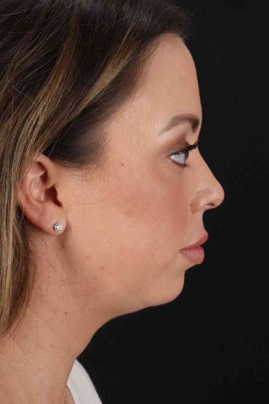 Buccal Fat Pad Before & After Patient #6474