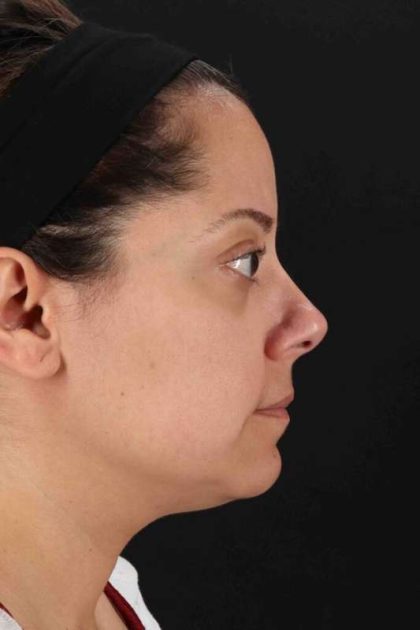 Buccal Fat Pad Before & After Patient #6485
