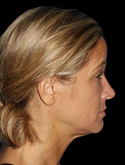 Neck Lift Before & After Patient #6517