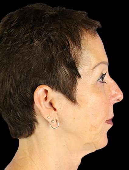 Neck Lift Before & After Patient #6528