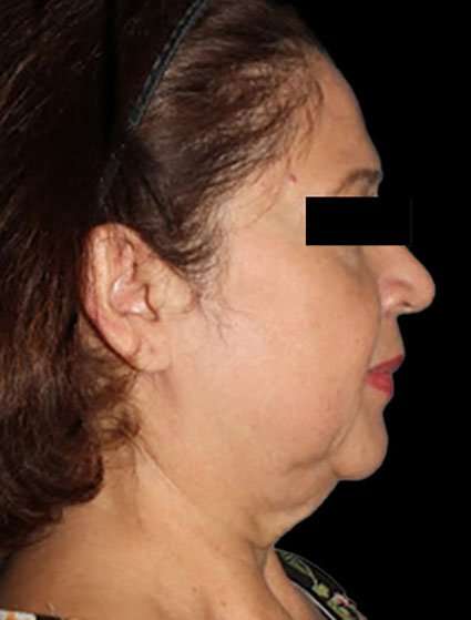Neck Lift Before & After Patient #6539
