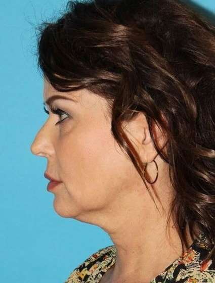 Neck Lift Before & After Patient #6546