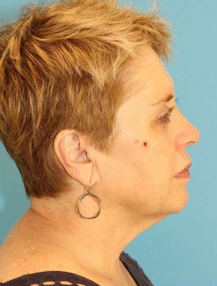 Neck Lift Before & After Patient #6565