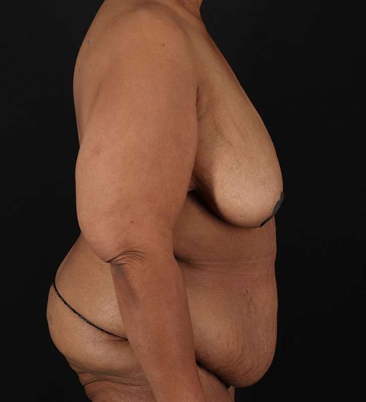 Cosmetic Body Lift Before & After Patient #1234