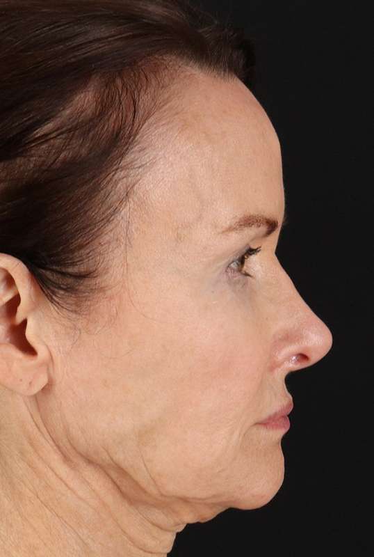Neck Lift Before & After Patient #6631