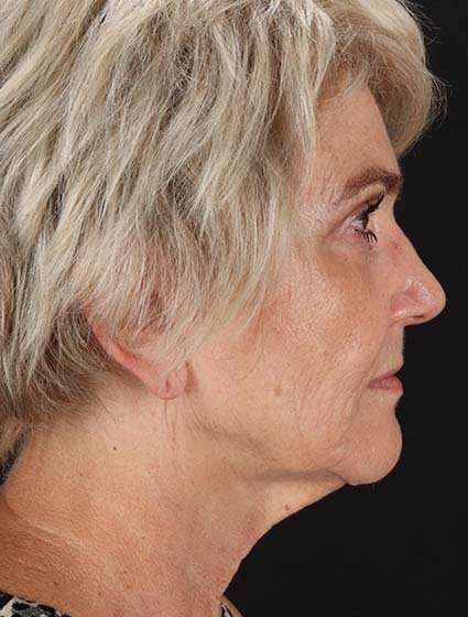 Neck Lift Before & After Patient #6654