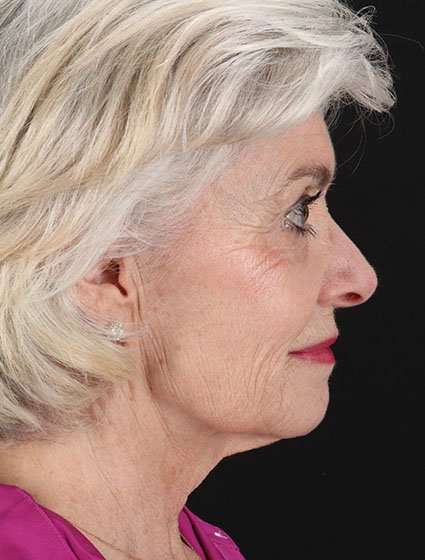 Neck Lift Before & After Patient #6665